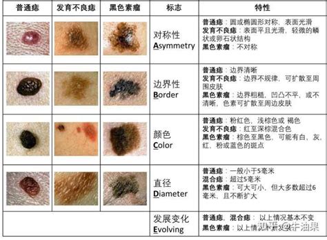 突出來的痣|痣是什麼？會變成黑色素瘤？7種一定要除的痣